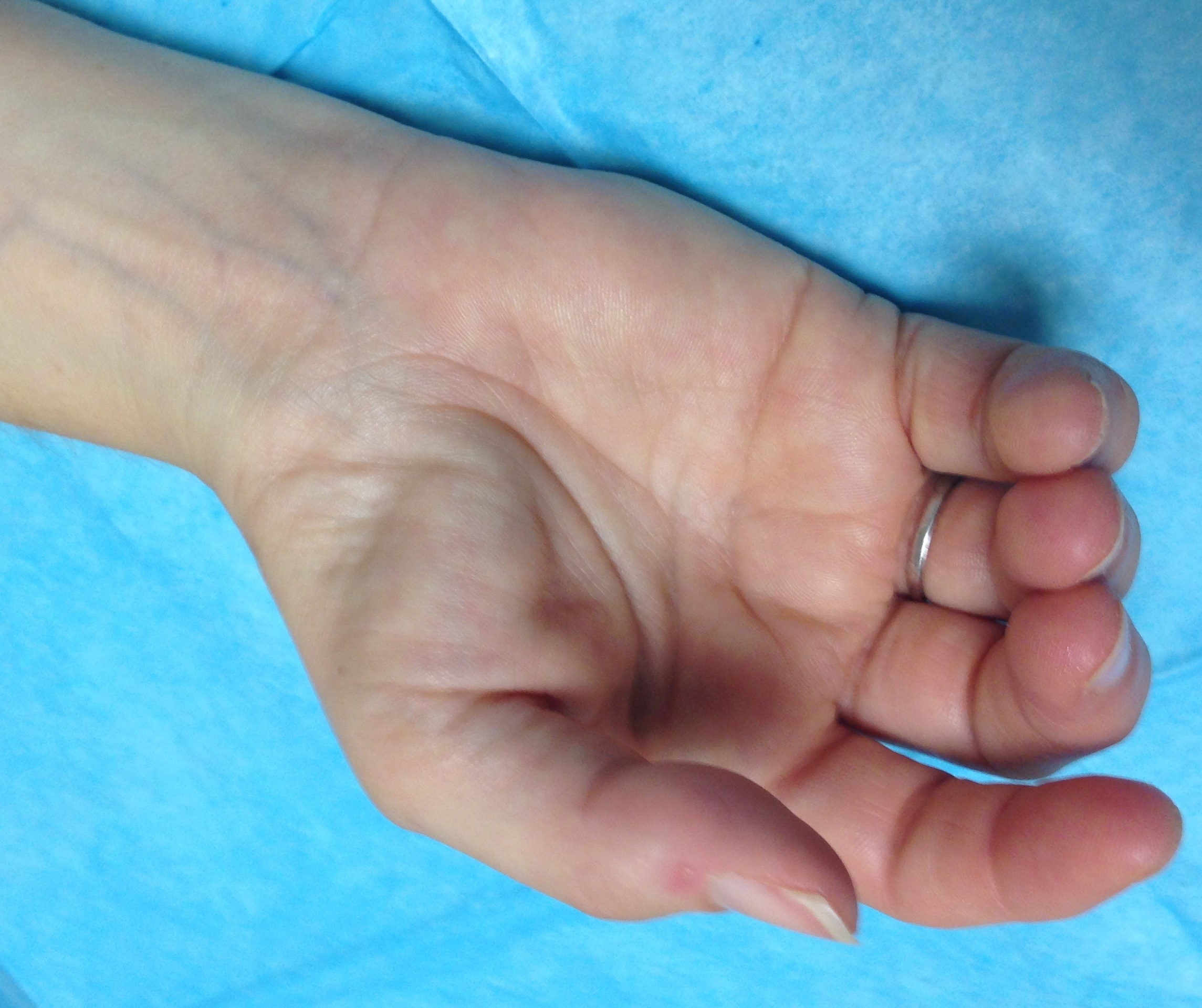 Thenar Muscle Atrophy Hand Surgery Source